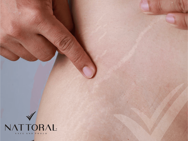 Have you noticed some lines on your skin? Here’s what they are and what you can do about it - nattoral